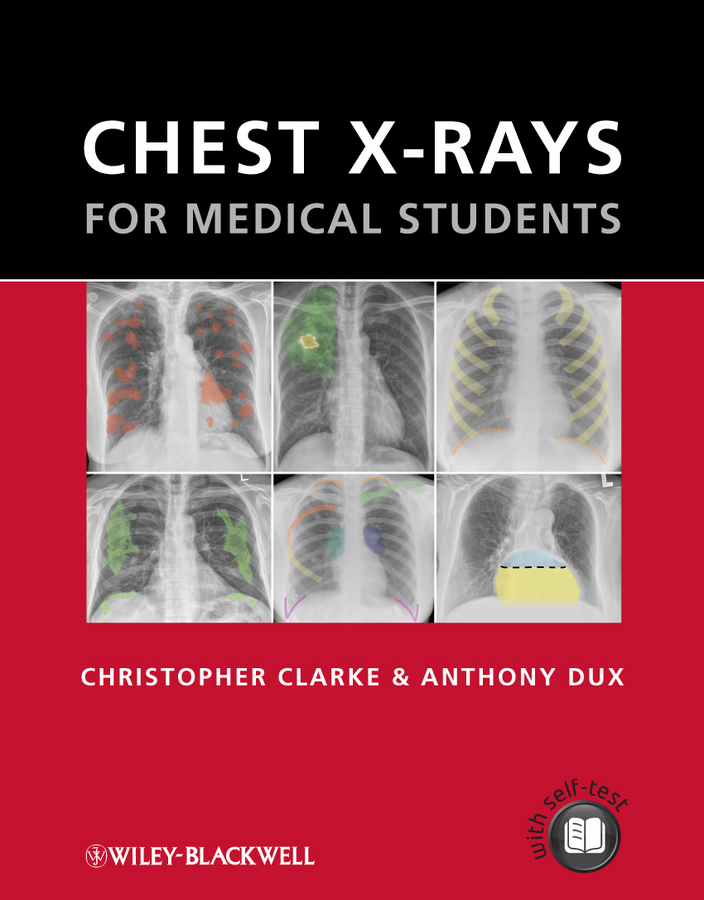 Chest X-rays for Medical Students