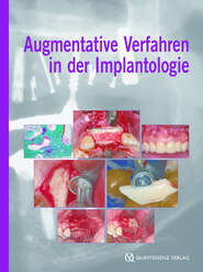 Augmentative Verfahren in der Implantologie