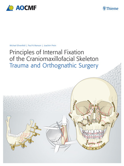 

Principles of Internal Fixation of the Craniomaxillofacial Skeleton