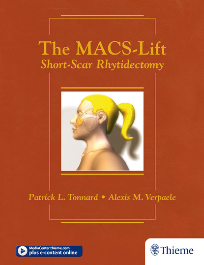 

The MACS-Lift